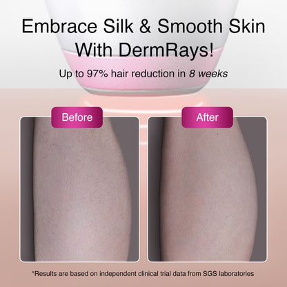 DermRays V6S Diode Laser Hair Removal, 1064nm, Specifically For Dark Skin